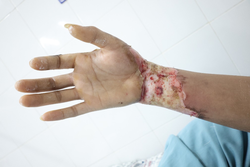 Vết thương trên tay của một ca bệnh bị bỏng do điện giật điều trị tại Bệnh viện