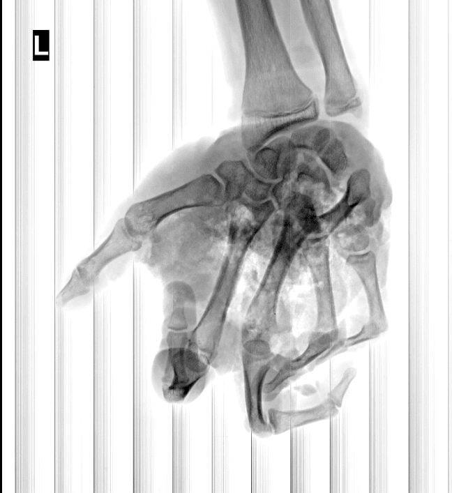 Pháo nổ - Mối nguy rình rập mỗi dịp Tết đến 2 a2 10