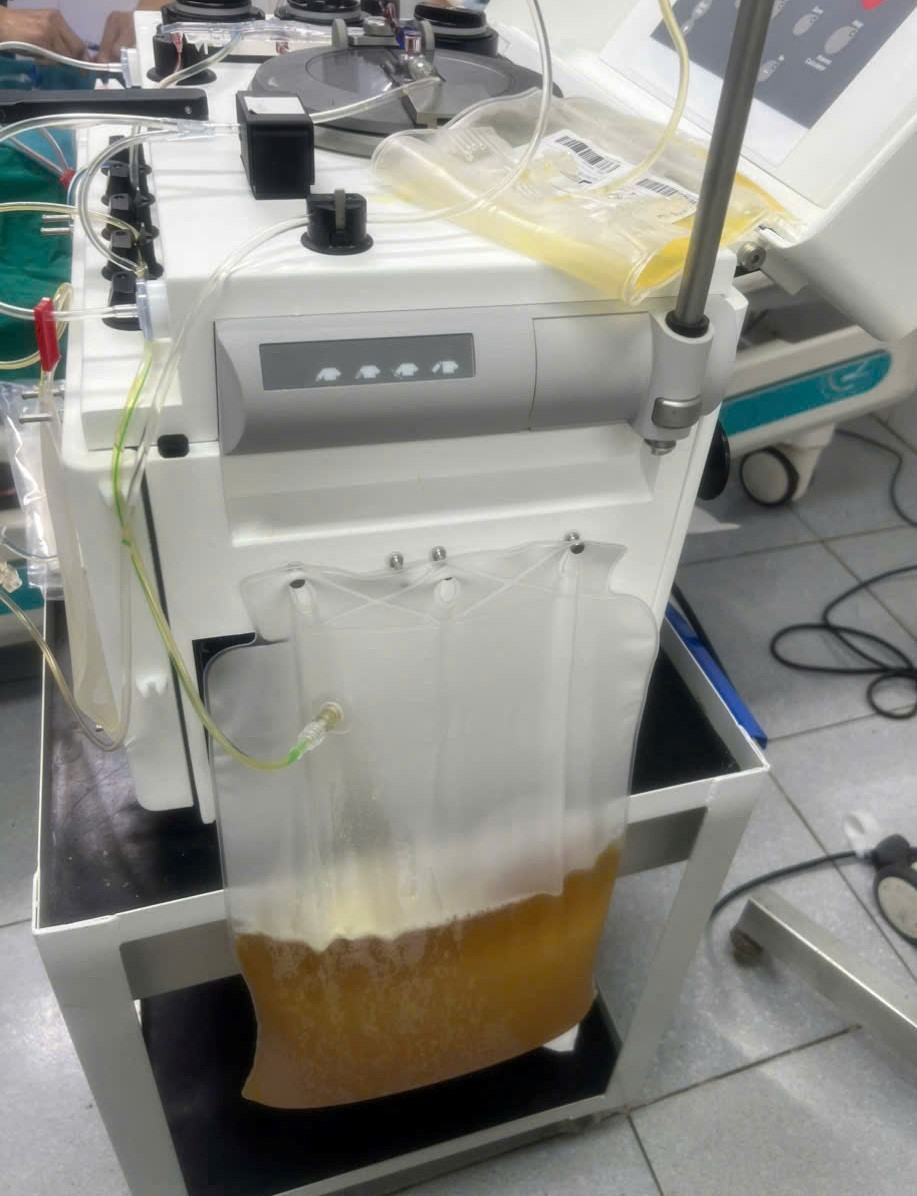 Hình ảnh túi huyết tương của người bệnh được tách ra