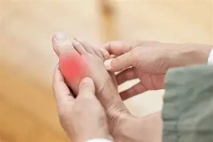 Những điều cần lưu ý với người bệnh Gout trong ngày Tết 2 Hình ảnh bàn chân người bệnh gout