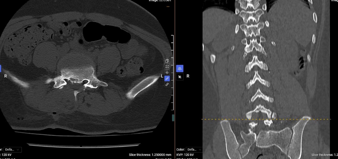 Thoát vị đĩa đệm đốt sống thắt lưng – Cảnh giác với bệnh lý hiếm gặp ở trẻ em và thanh thiếu niên 4 Hình ảnh phim chụp CT của người bệnh sau phẫu thuật