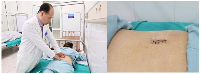 Thoát vị đĩa đệm đốt sống thắt lưng – Cảnh giác với bệnh lý hiếm gặp ở trẻ em và thanh thiếu niên 5 BSCKII Hà Xuân Tài kiểm tra vết mổ cho người bệnh và hình ảnh đường mổ rất nhỏ giúp người bệnh ít đau và nhanh hồi phục.