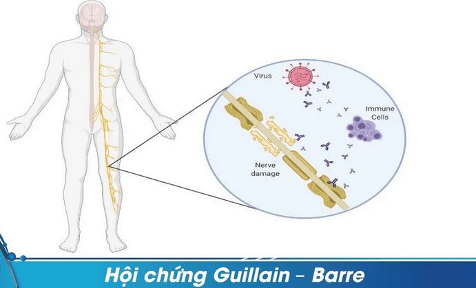 Hội chứng Guillain –Barré (Hình ảnh minh họa)