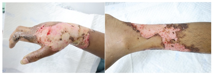 Tình trạng vết thương của người bệnh khi nhập viện.