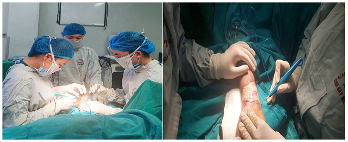 Ekip thực hiện phẫu thuật ghép da vùng cổ tay cho người bệnh.