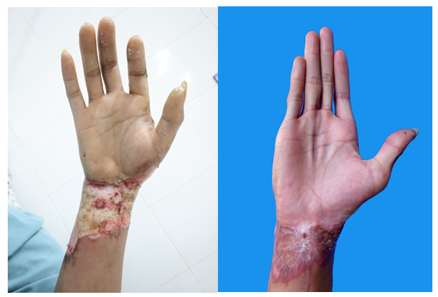 Cổ tay trước phẫu thuật và Cổ tay sau phẫu thuật