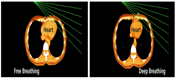 Xạ trị ung thư vú: không chỉ kiểm soát khối u mà còn bảo vệ trái tim 1 Bảo vệ tim – ưu tiên hàng đầu trong xạ trị ung thư vú
