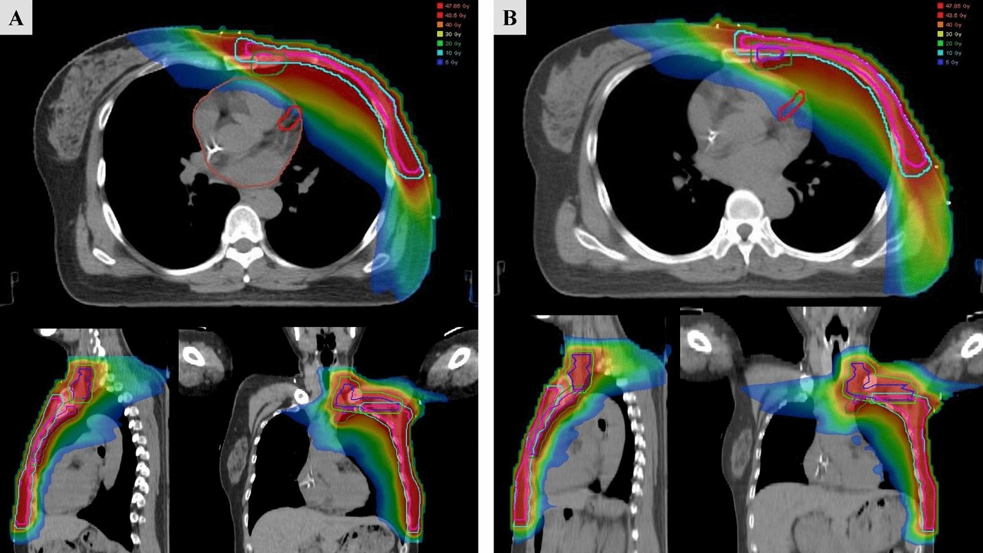 Xạ trị ung thư vú: không chỉ kiểm soát khối u mà còn bảo vệ trái tim 2 Phân bố liều trong (A) DIBH (Deep Inspiration Breath-Hold – hít sâu nín thở) và (B) FB (Free Breathing – thở tự do) theo kỹ thuật VMAT ở một người bệnh điển hình được chiếu xạ hạch vú trong. Các đường viền màu biểu thị CTV (thể tích bia lâm sàng) và PTV (thể tích bia lập kế hoạch) của vùng thượng đòn/hạ đòn, thành ngực và chuỗi hạch vú trong.