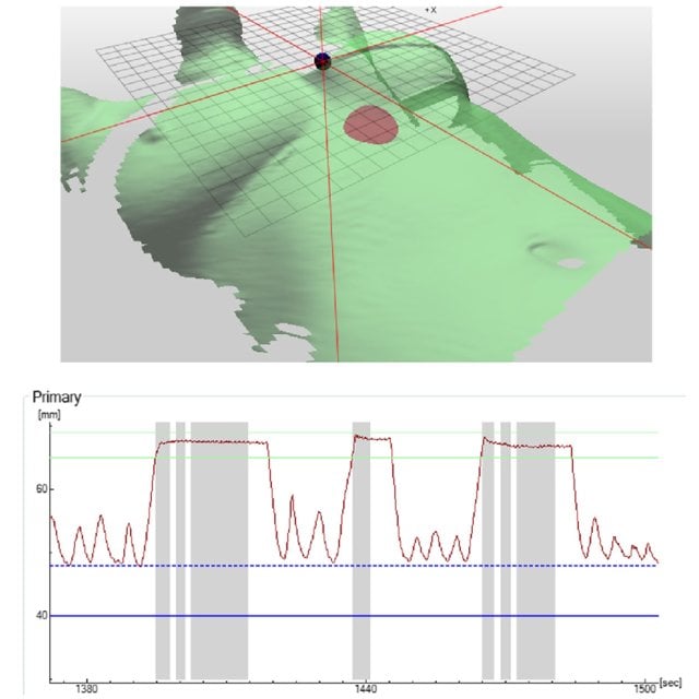 Xạ trị ung thư vú: không chỉ kiểm soát khối u mà còn bảo vệ trái tim 3 C-RAD kết hợp DIBH cho phép theo dõi bề mặt cơ thể theo thời gian thực trong suốt quá trình xạ trị, giúp kiểm soát chính xác nhịp thở, hạn chế sai số vị trí và nâng cao khả năng bảo vệ tim, phổi cho người bệnh.