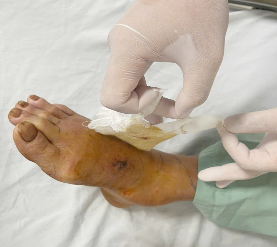 Vết thương của người bệnh N do rắn cắn