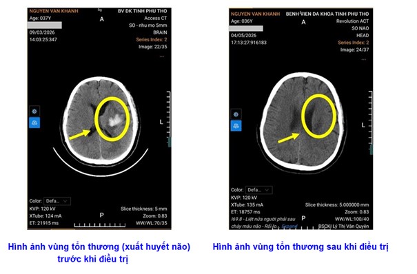 xuất huyết não
