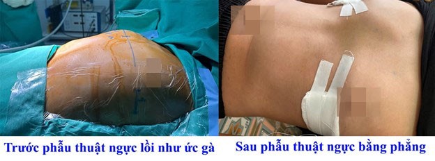 Hướng dẫn theo dõi người bệnh sau phẫu thuật điều trị dị dạng lồng ngực