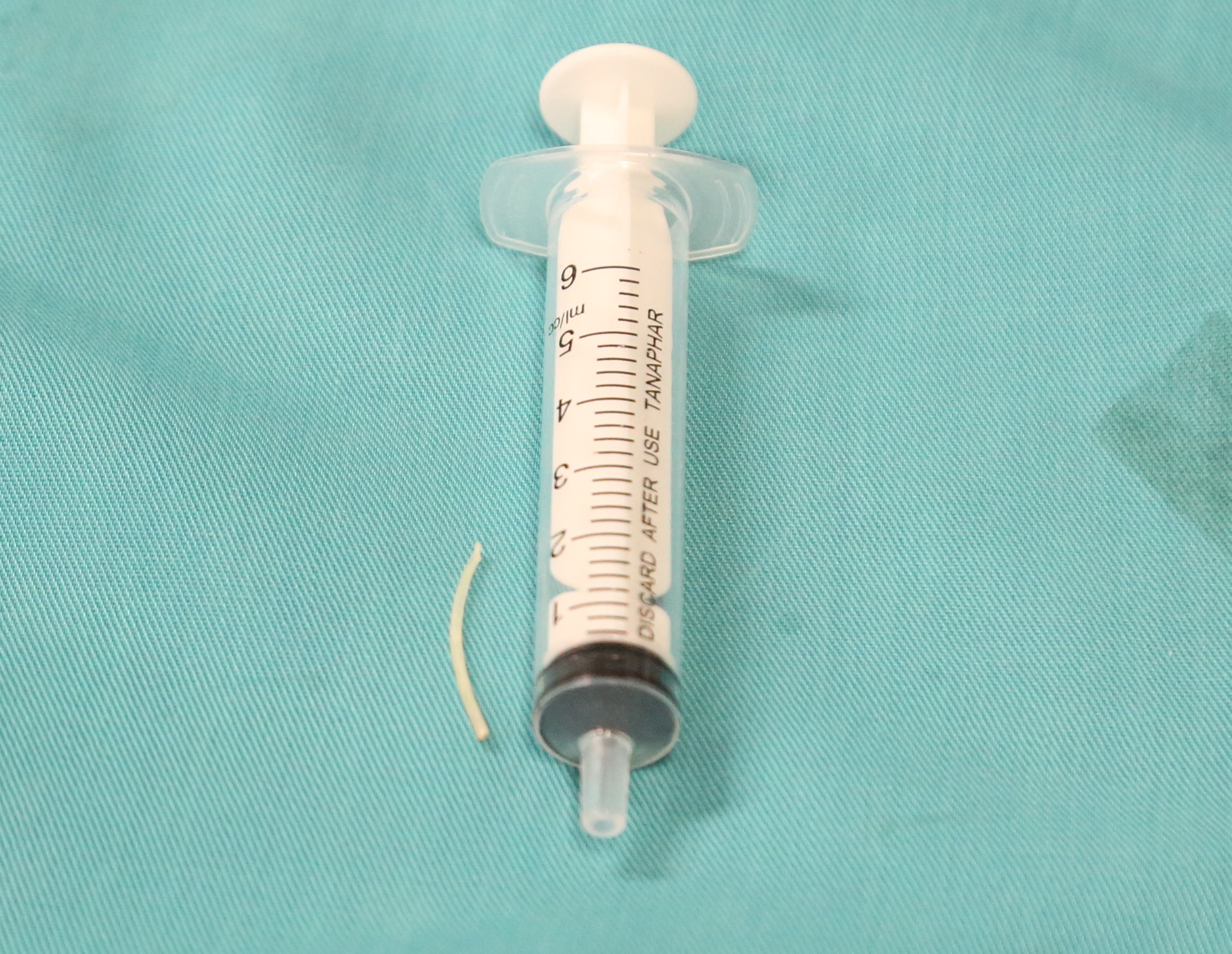 Chữa hóc xương cá bằng mẹo dân gian, bé trai 9 tuổi bị áp xe thực quản