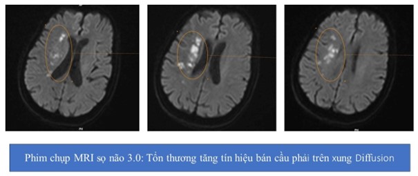 Cảnh báo: Chủ quan tự điều trị tại nhà, người phụ nữ bỏ lỡ "giờ vàng" cấp cứu đột quỵ