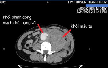 vỡ phình động mạch chủ bụng