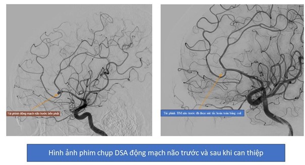 Người đàn ông 39 tuổi xuất huyết não do vỡ túi phình mạch máu não: Đừng chủ quan vì còn trẻ 5 xuất huyết não do vỡ túi phình mạch máu não