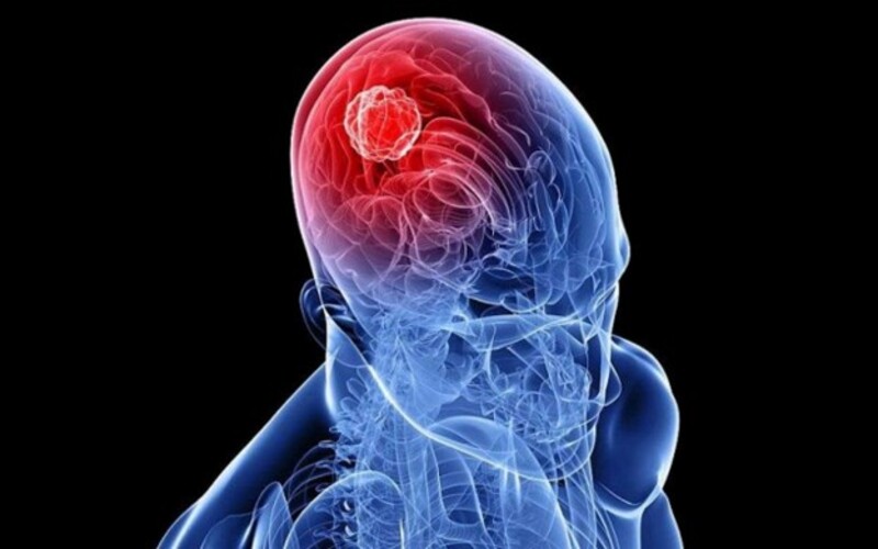 U não: Đừng chủ quan với những dấu hiệu cảnh báo sớm 3 u não