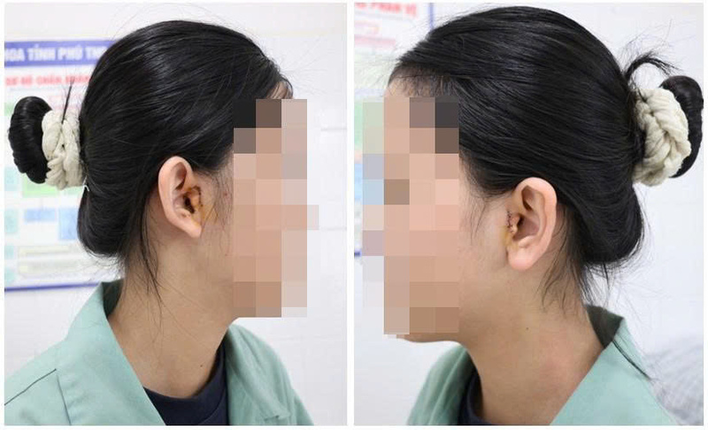 Sụn da thừa trước tai: Can thiệp nhỏ, mang lại sự tự tin 7 Sun da thua truoc tai 3