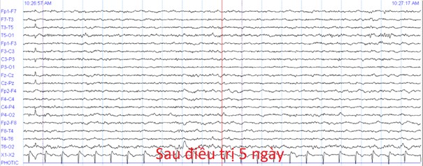 co giat keo dai 4