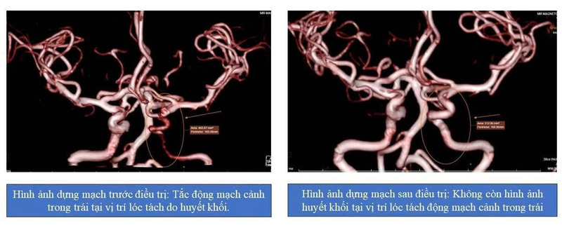 lóc tách động mạch cảnh trong