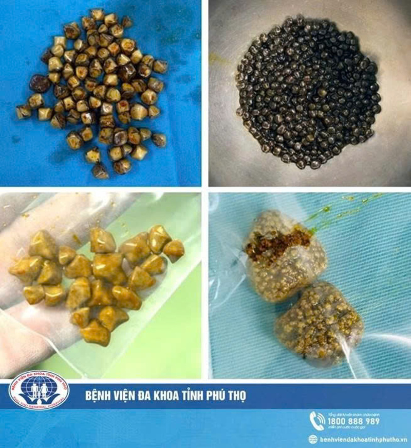 49 vien soi trong tui mat nguoi phu nu 1