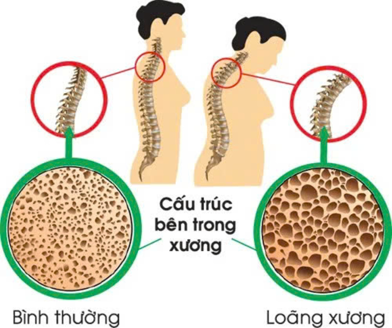 Dieu tri loang xuong bang khang the don dong 1
