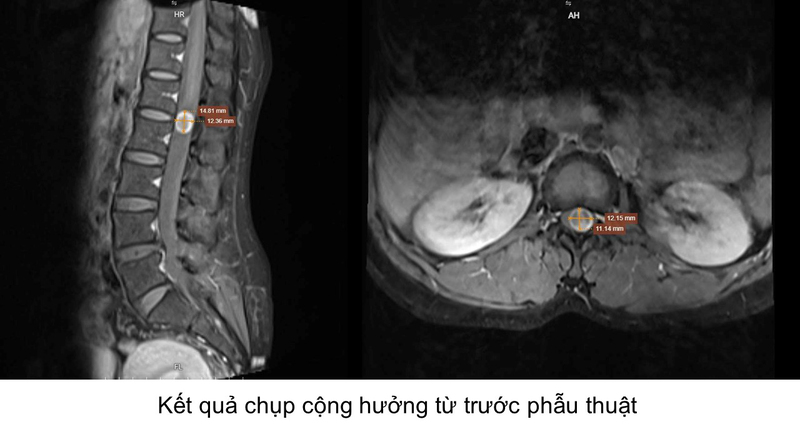 Phau thuat noi soi AUSS dieu tri u tuy 2