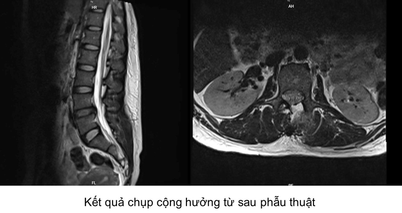 Phau thuat noi soi AUSS dieu tri u tuy 3